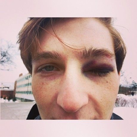Black eye