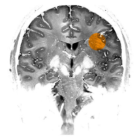 Ultrahighresonanztomographie 2