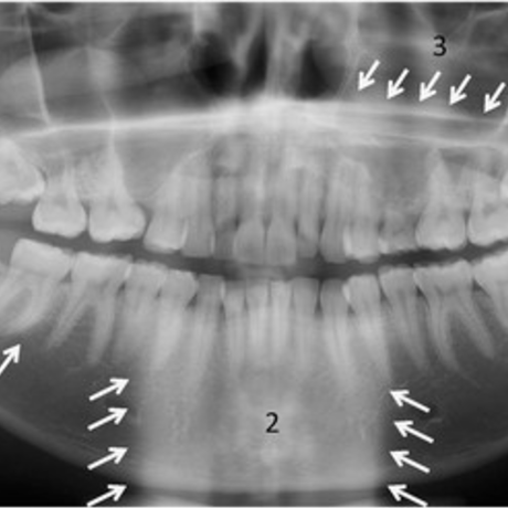 Main anatomical ghost shadows in a ptg 1 contralateral angle and body of the mandible